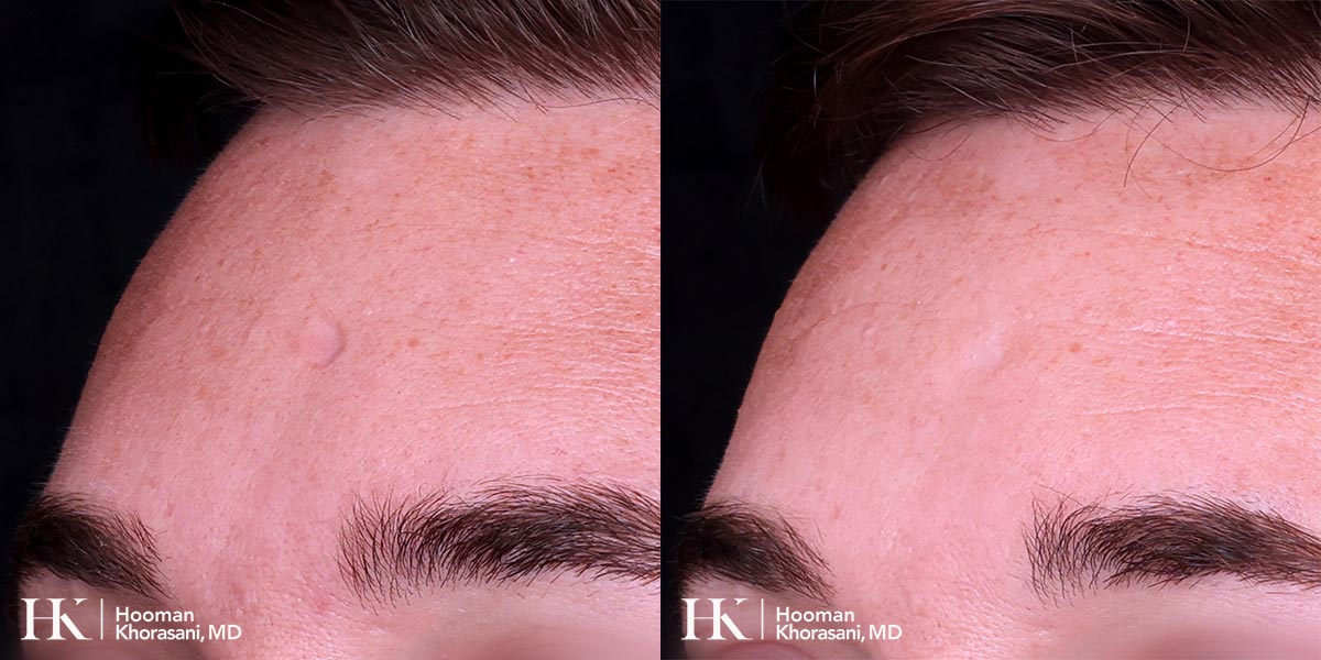 Scar Revision Using Bellafill INjections by Dr. Hooman Khorasani