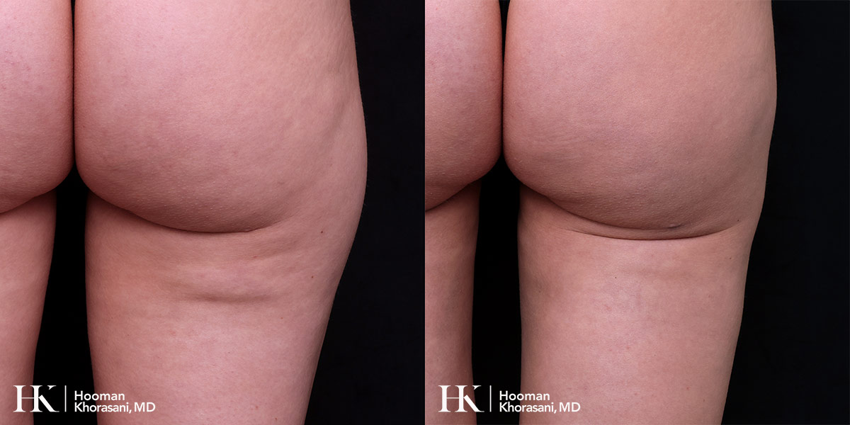 Fat Transfer to correct contour deformity by Dr. Hooman Khorasani NYC