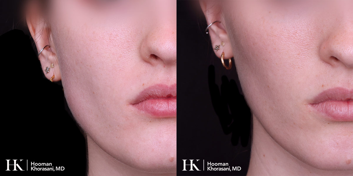 Cheek & Jaw Contouring using Dysport by Dr. Hooman Khorasani