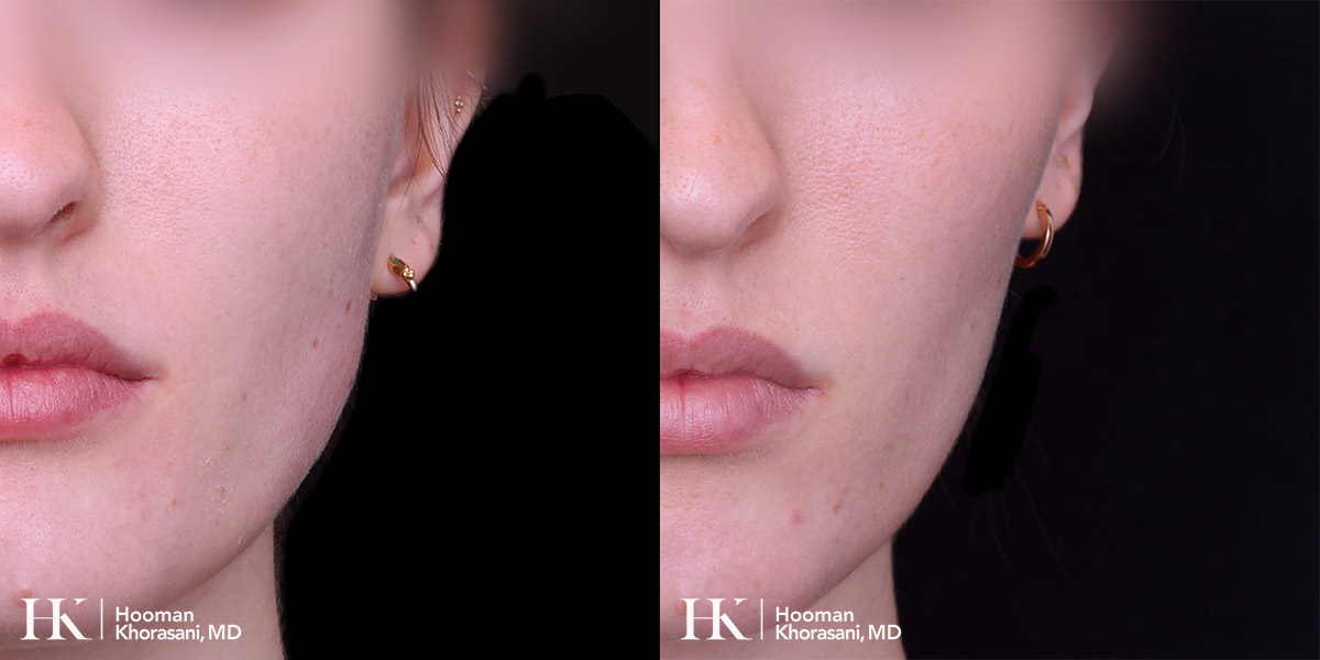 Cheek & Jaw Contouring using Dysport by Dr. Hooman Khorasani