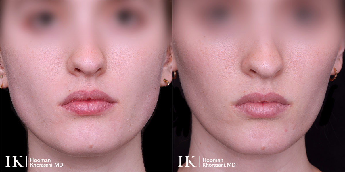 Cheek & Jaw Contouring using Dysport by Dr. Hooman Khorasani