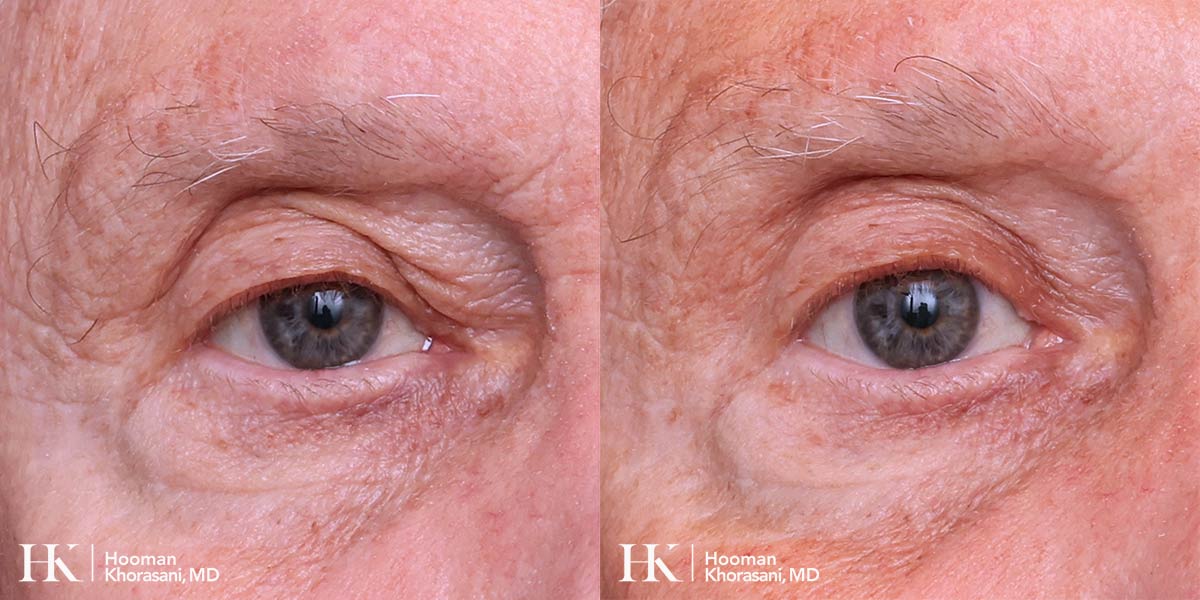 Eyelid Surgery Upper Blepharoplasty by Dr. Hooman Khorasani