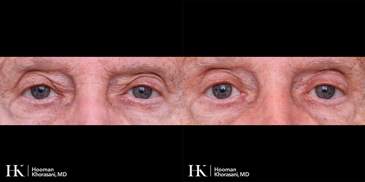 Eyelid Surgery Upper Blepharoplasty by Dr. Hooman Khorasani