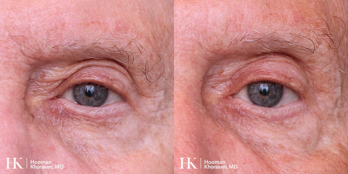 Eyelid Surgery Upper Blepharoplasty by Dr. Hooman Khorasani
