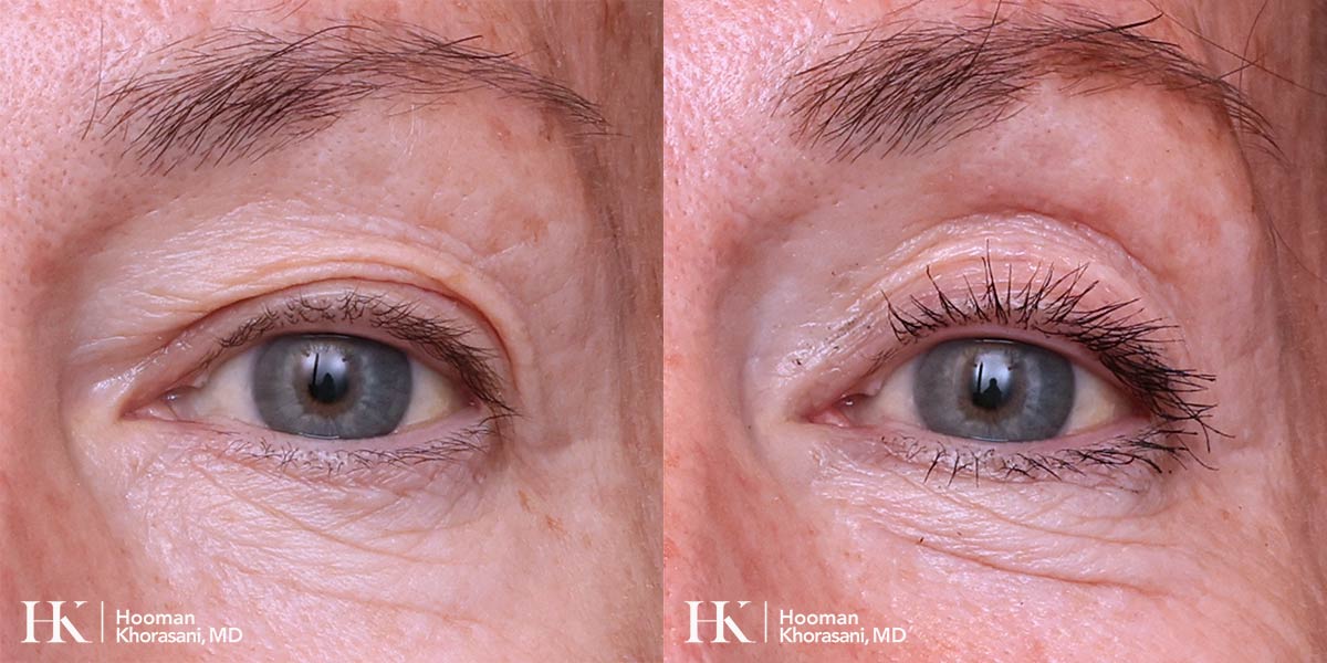 Eyelid Surgery Upper Blepharoplasty by Dr. Hooman Khorasani