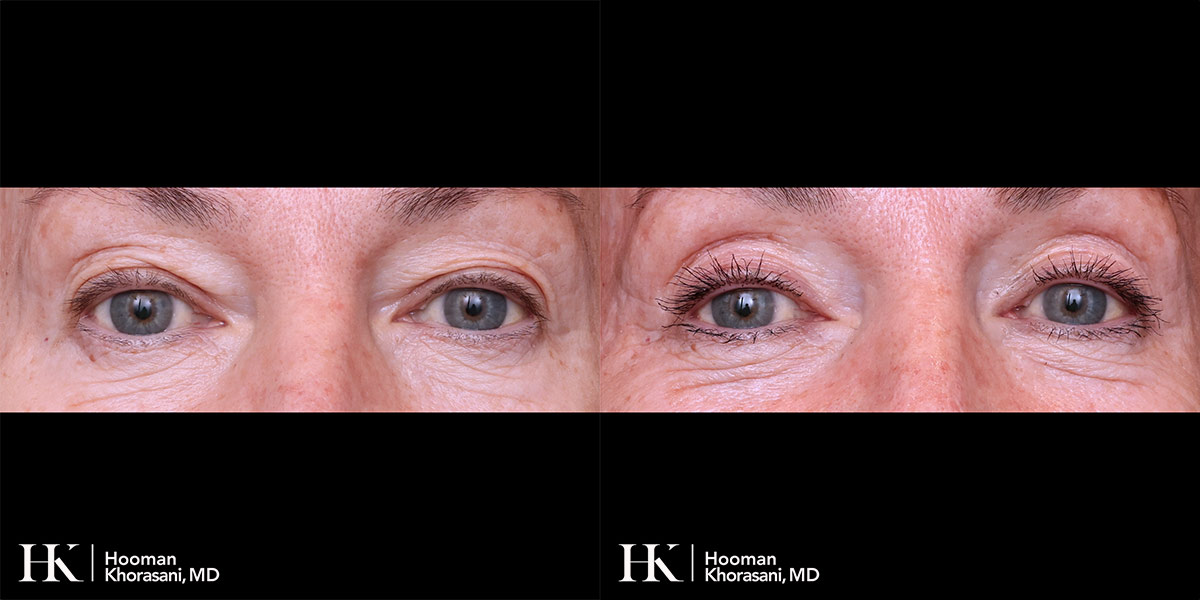 Eyelid Surgery Upper Blepharoplasty by Dr. Hooman Khorasani