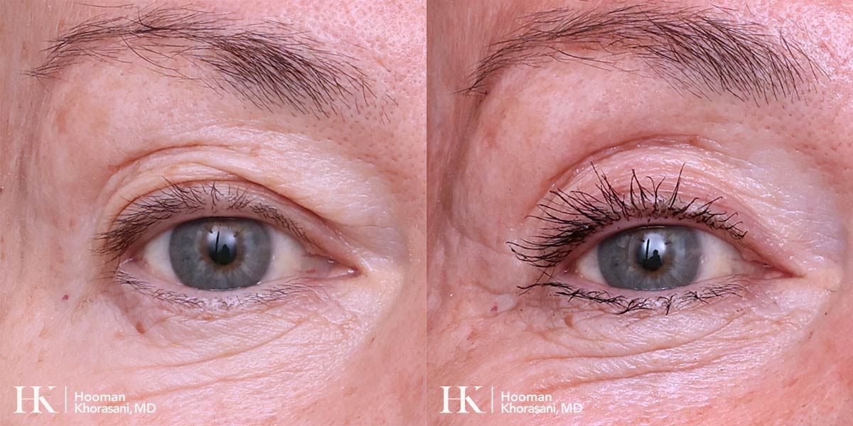 Eyelid Surgery Upper Blepharoplasty by Dr. Hooman Khorasani