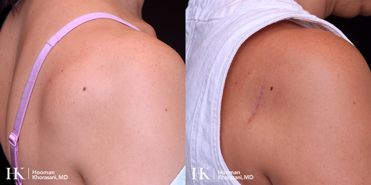 Shoulder Lipoma Removal Dr. Hooman Khorasani