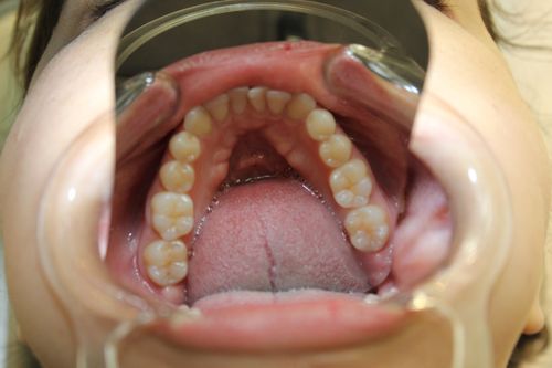 Invisalign in Montebello