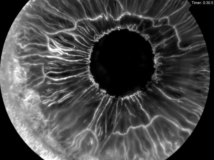 New vessels on the iris. Credit: Ashley Prytherch, Royal Surrey County Hospital NHS FT. Attribution 4.0 International (CC BY 4.0)