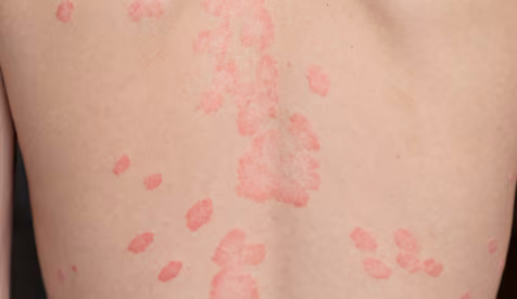 psoriasis