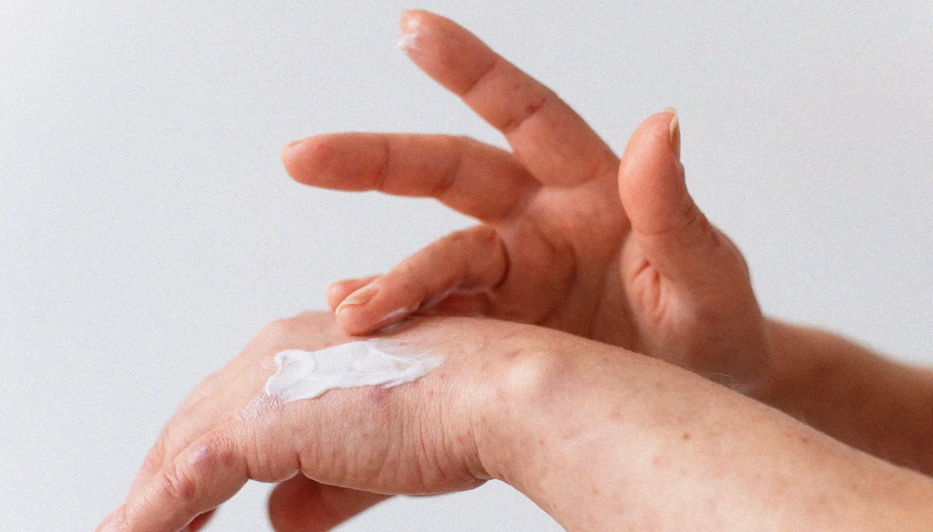 Une personne qui s'hydrate la peau de la main, car elle souffre d'eczéma.