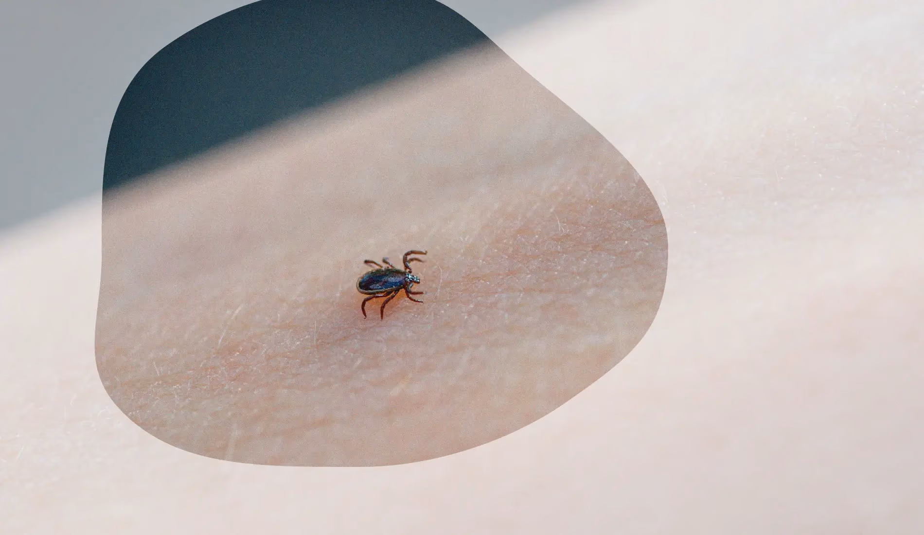 Maladie de Lyme et piqure de tique