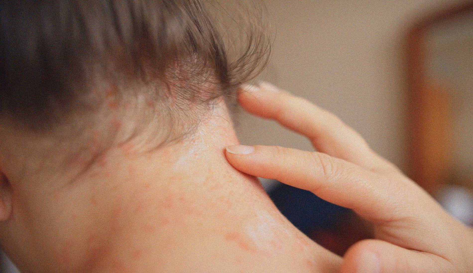 Allergie cutanée