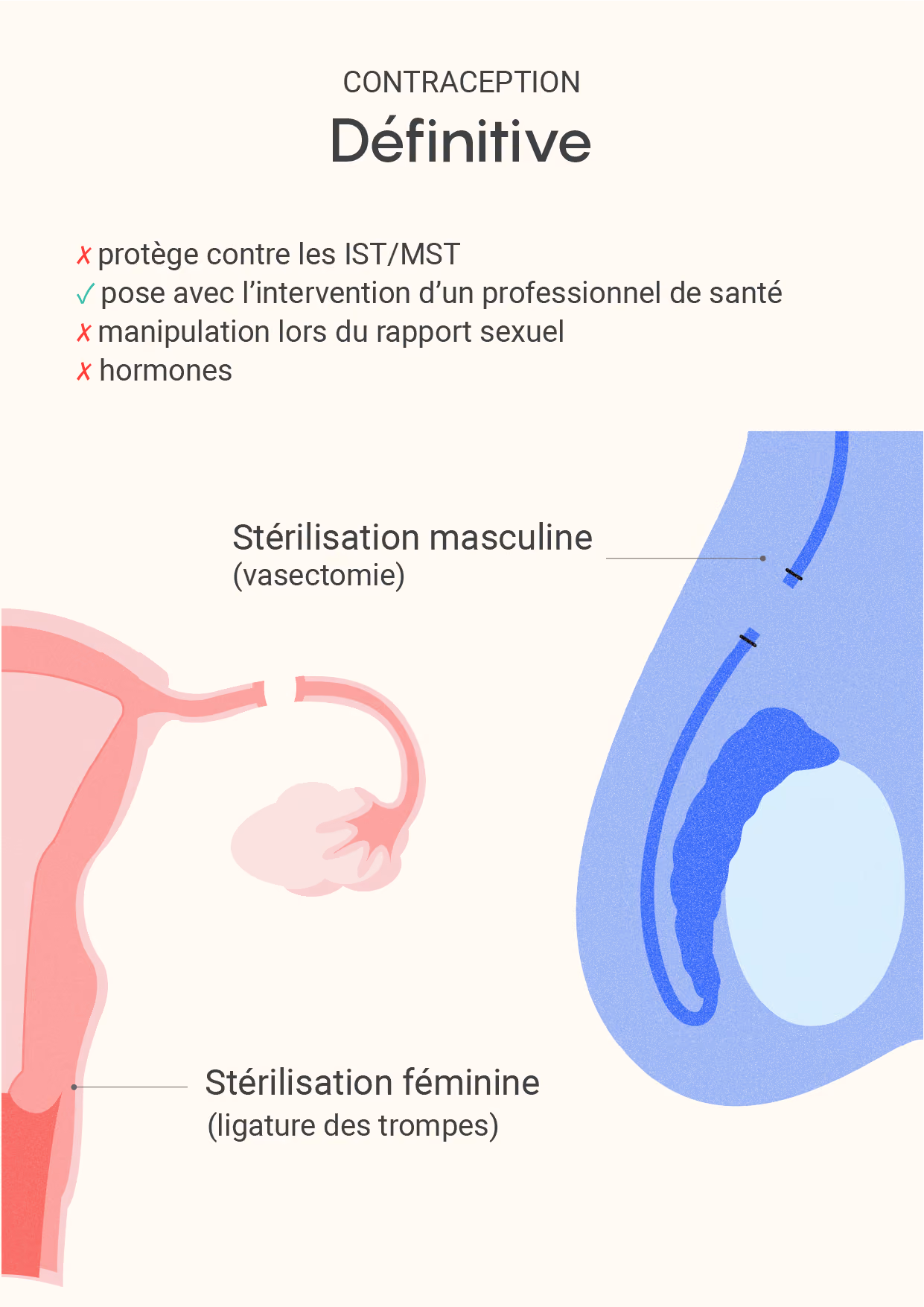 Contraceptions définitives
