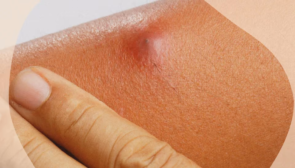 La peau d'une personne présentant un abcès.