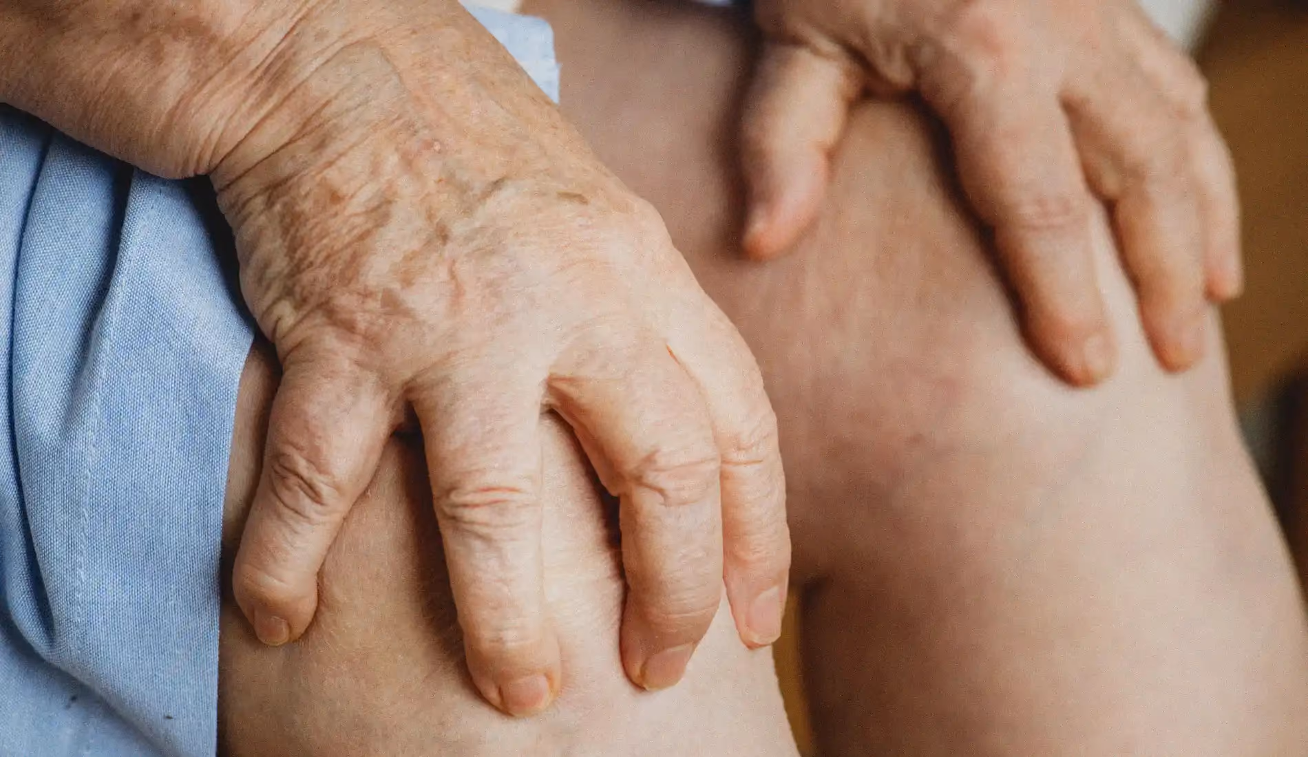Jambes présentant des varices, veines dilatées et tortueuses en surface, signe caractéristique de l'insuffisance veineuse chronique