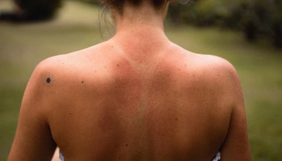 Le dos d'une personne atteinte de cancer de la peau.