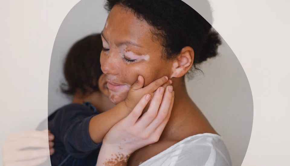 Vitiligo