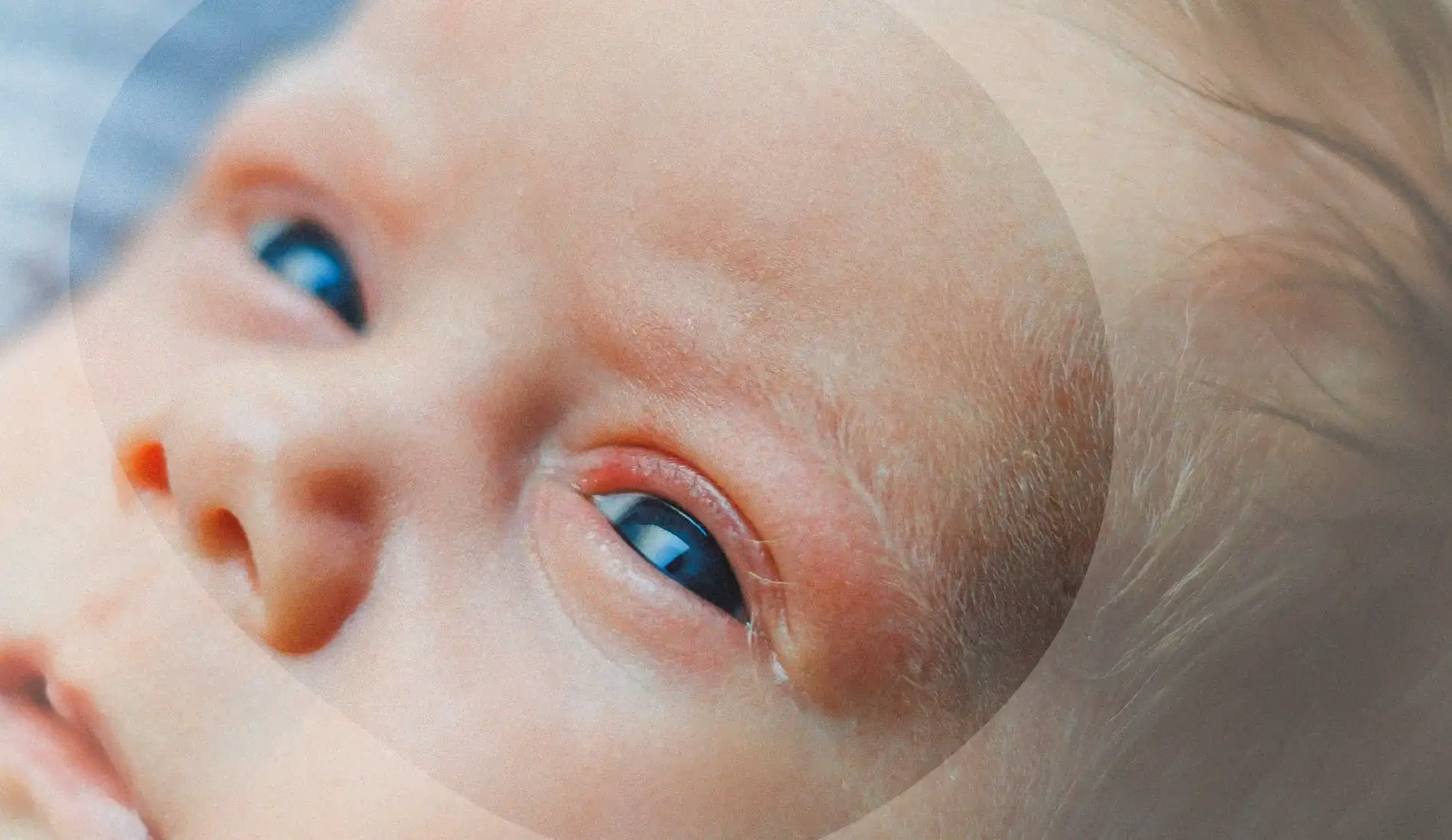 Nourrisson présentant un œil rouge et des paupières gonflées, symptômes visibles d'une conjonctivite bébé nécessitant un avis médical.