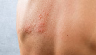 La peau du dos d'une personne envahie par une éruption cutanée