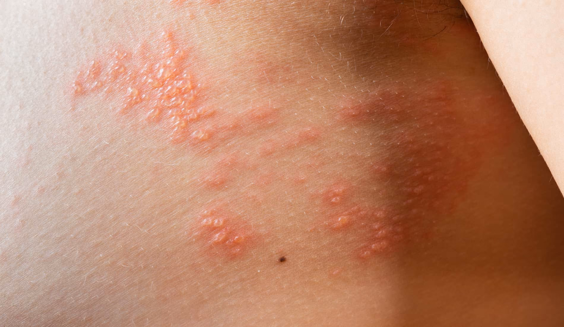 Eczéma bulleux ou dyshidrose