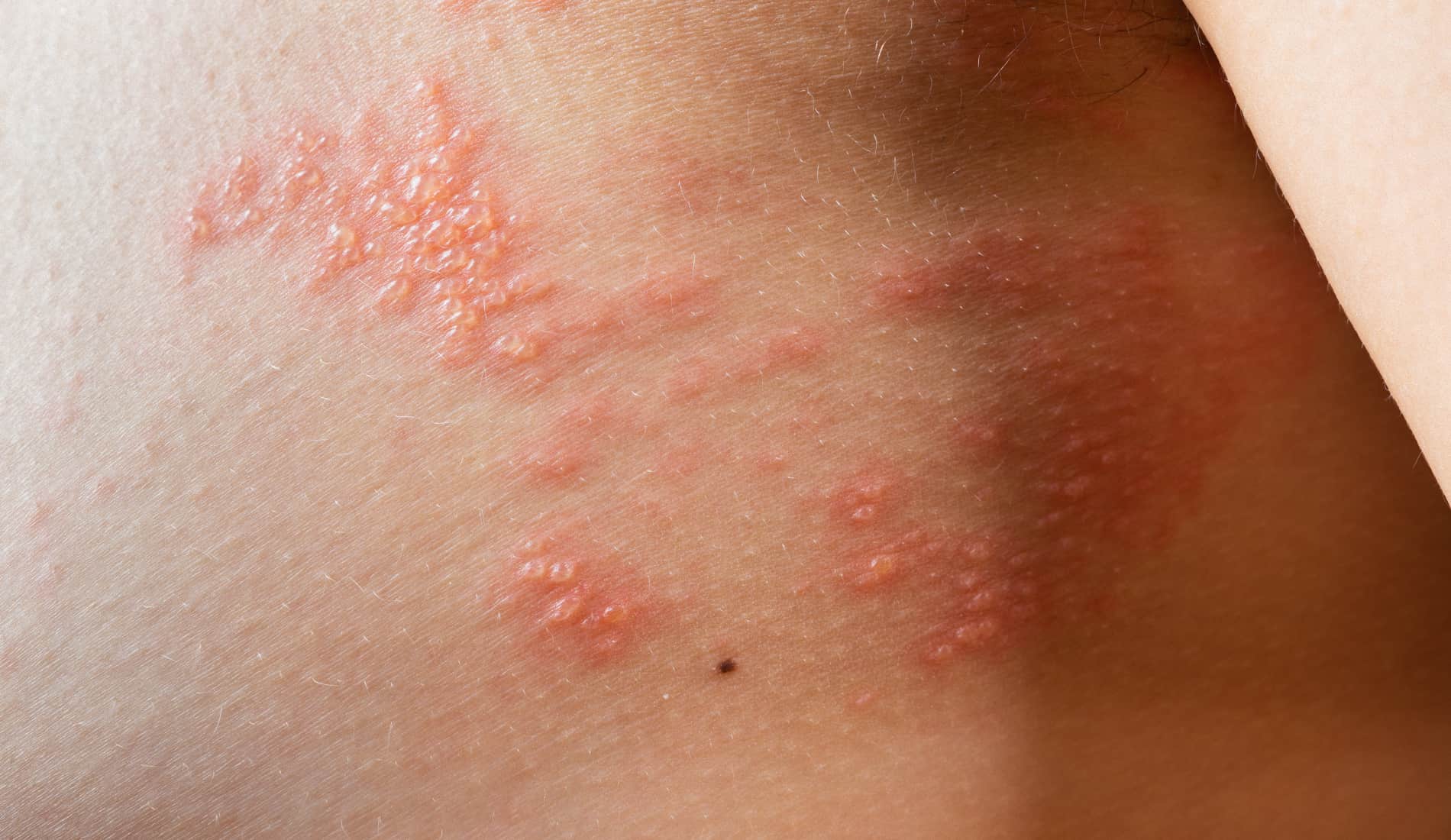 Eczéma bulleux ou dyshidrose