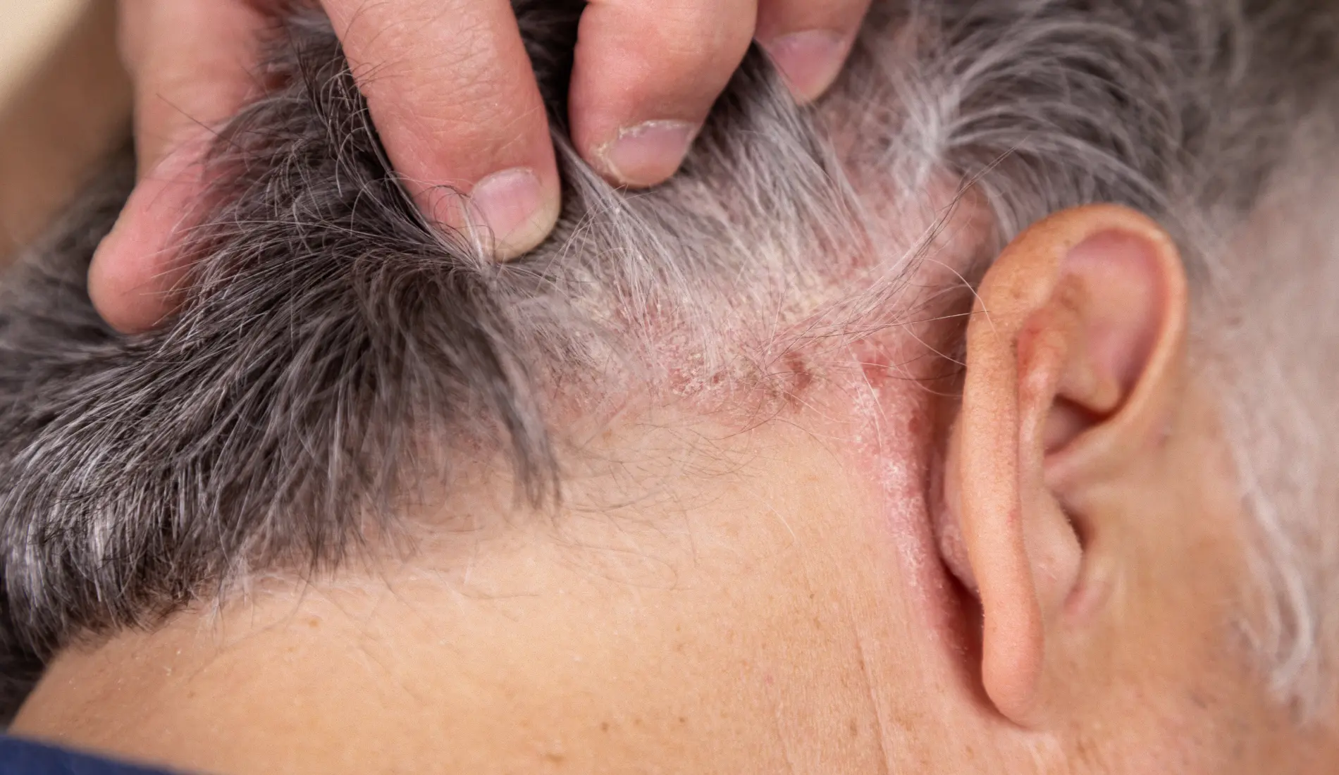 Psoriasis du cuir chevelu