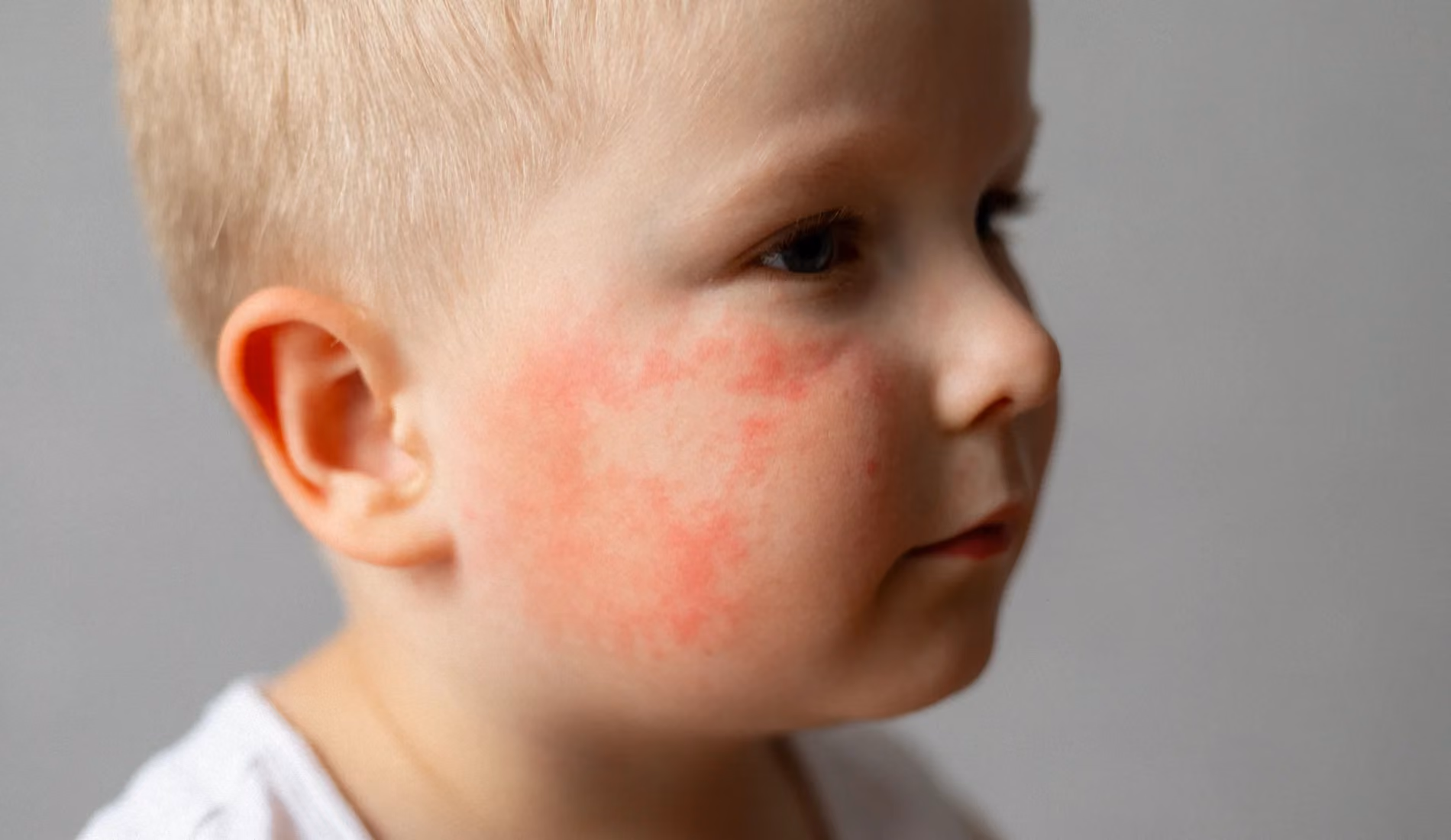 Eczéma du bébé : symptômes, causes et traitements