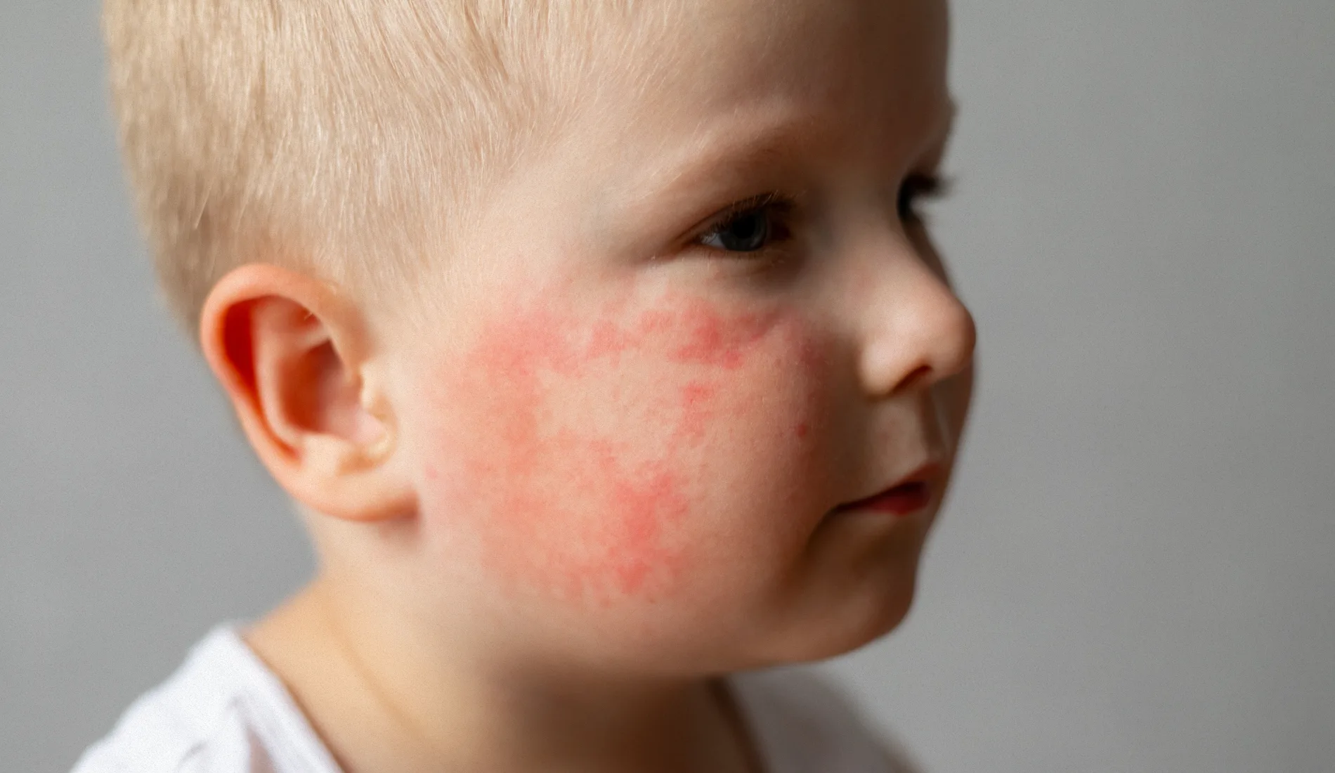 Eczéma du bébé : symptômes, causes et traitements