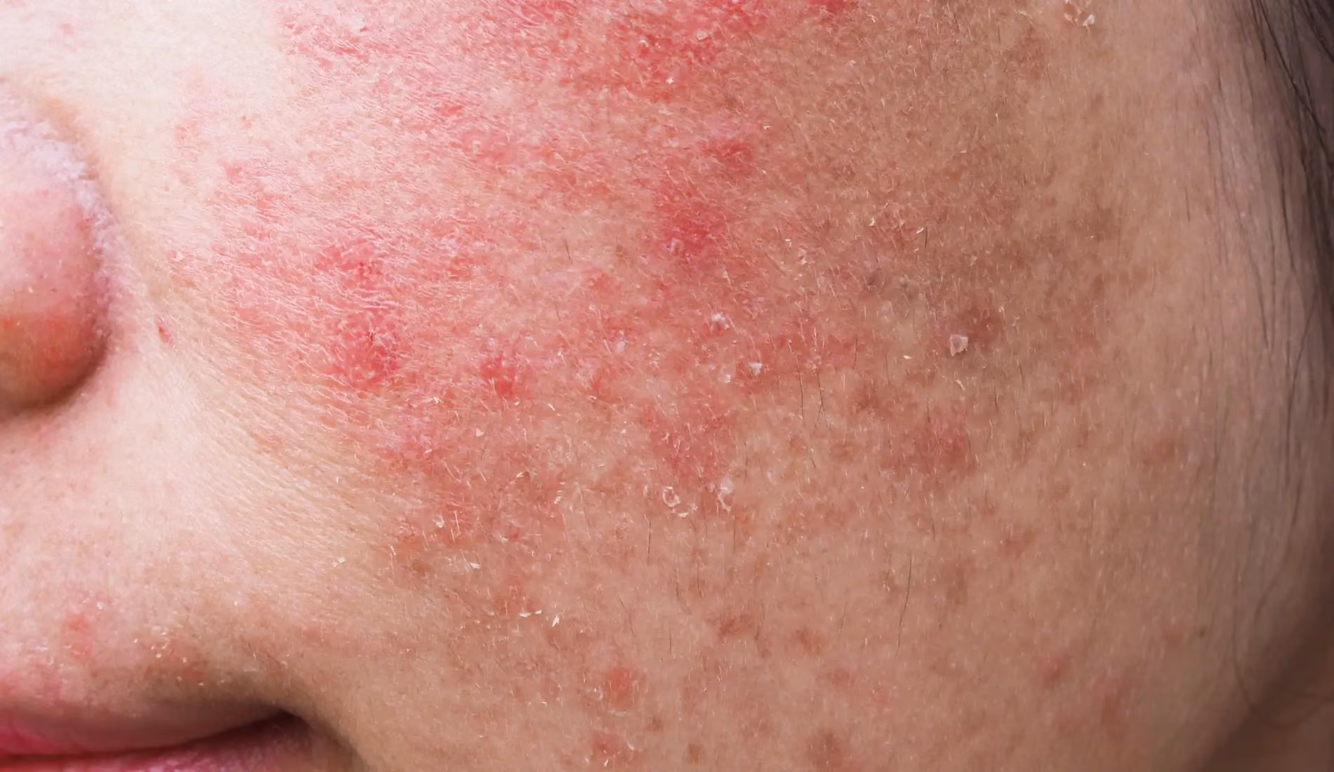 Gros plan sur des plaques rouges et squameuses au niveau de la joue, signe caractéristique de l'eczéma du visage