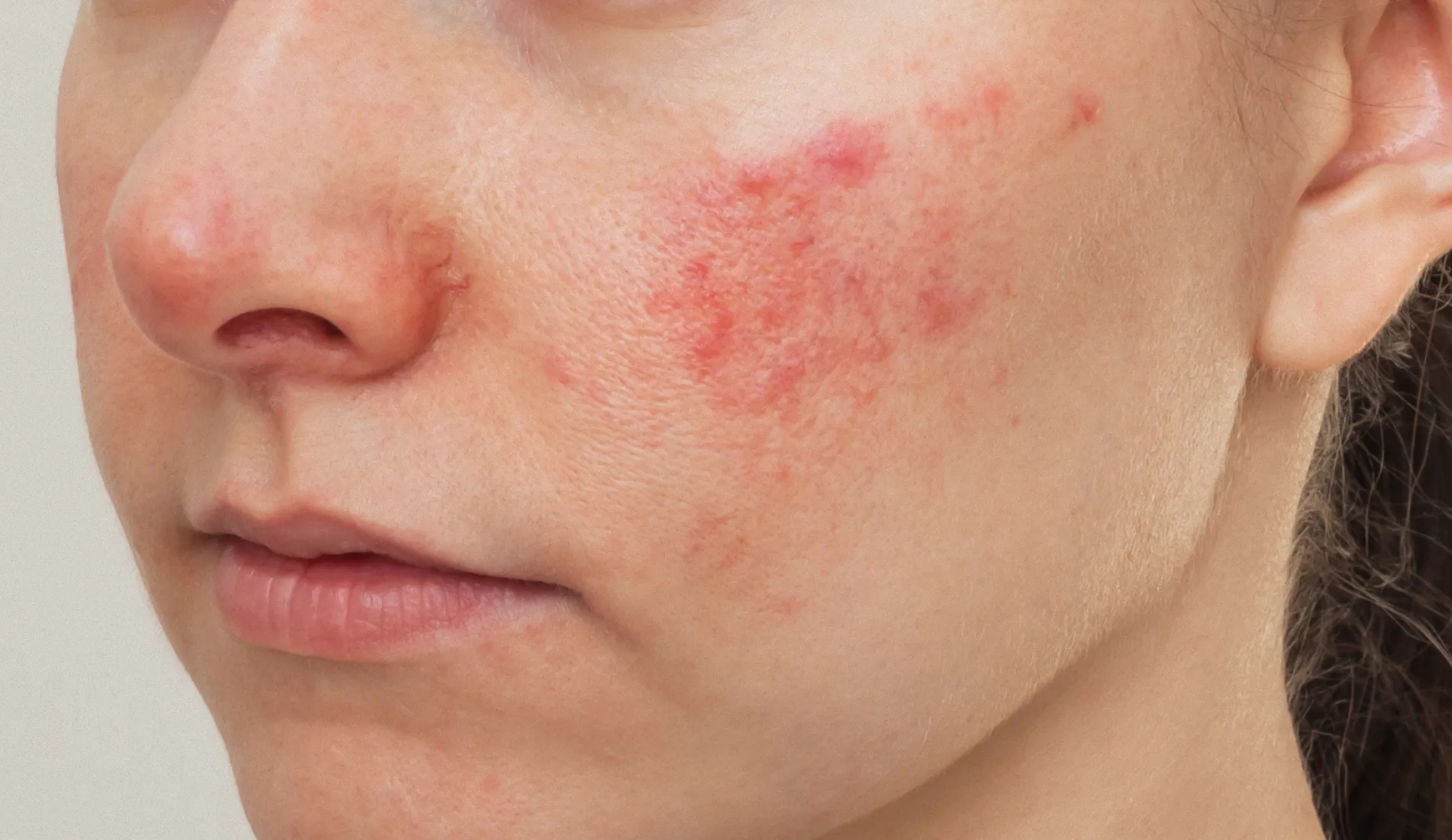 Acné rosacée