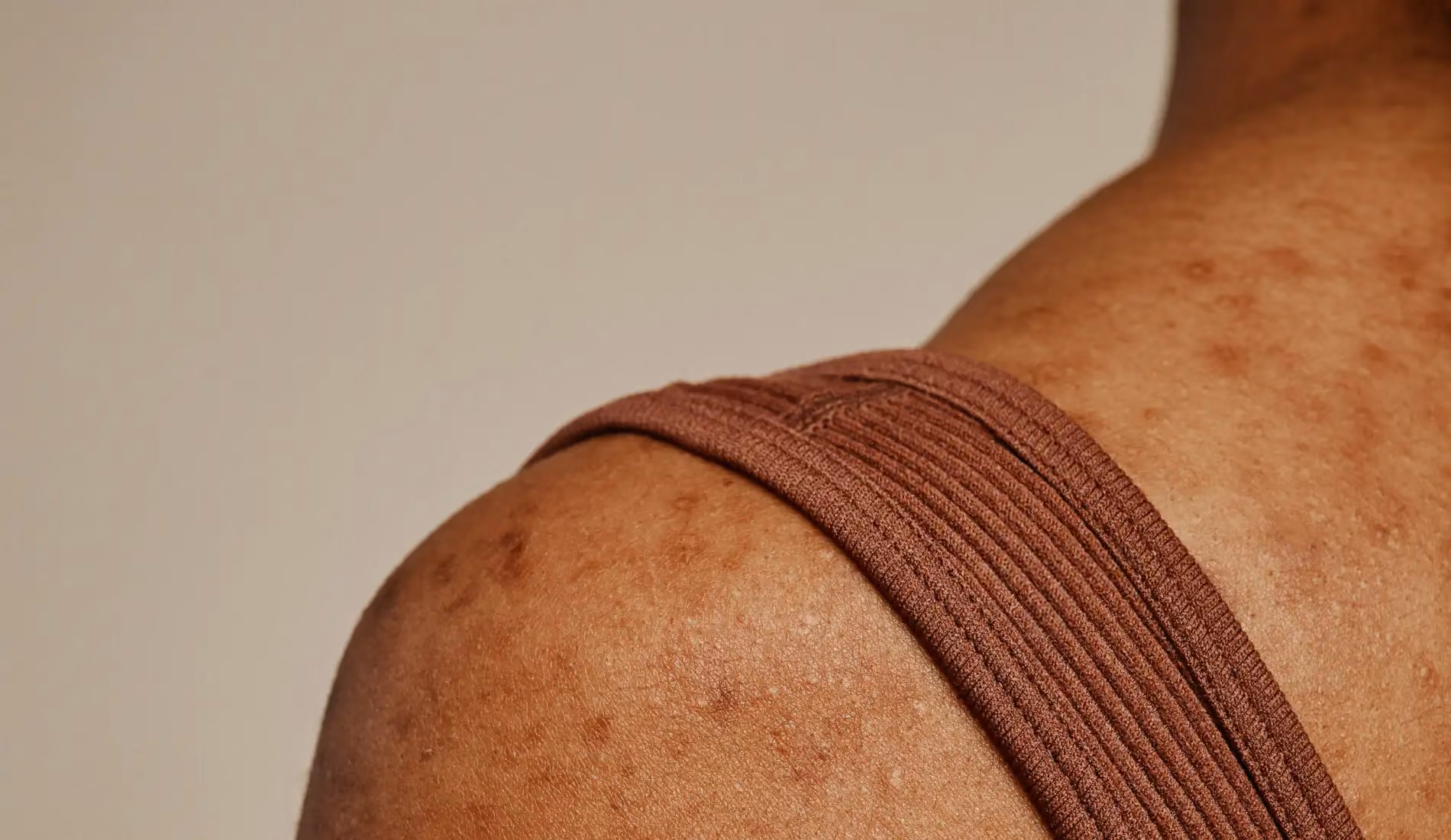 Une épaule dénudée sur laquelle on aperçoit de l'acné
