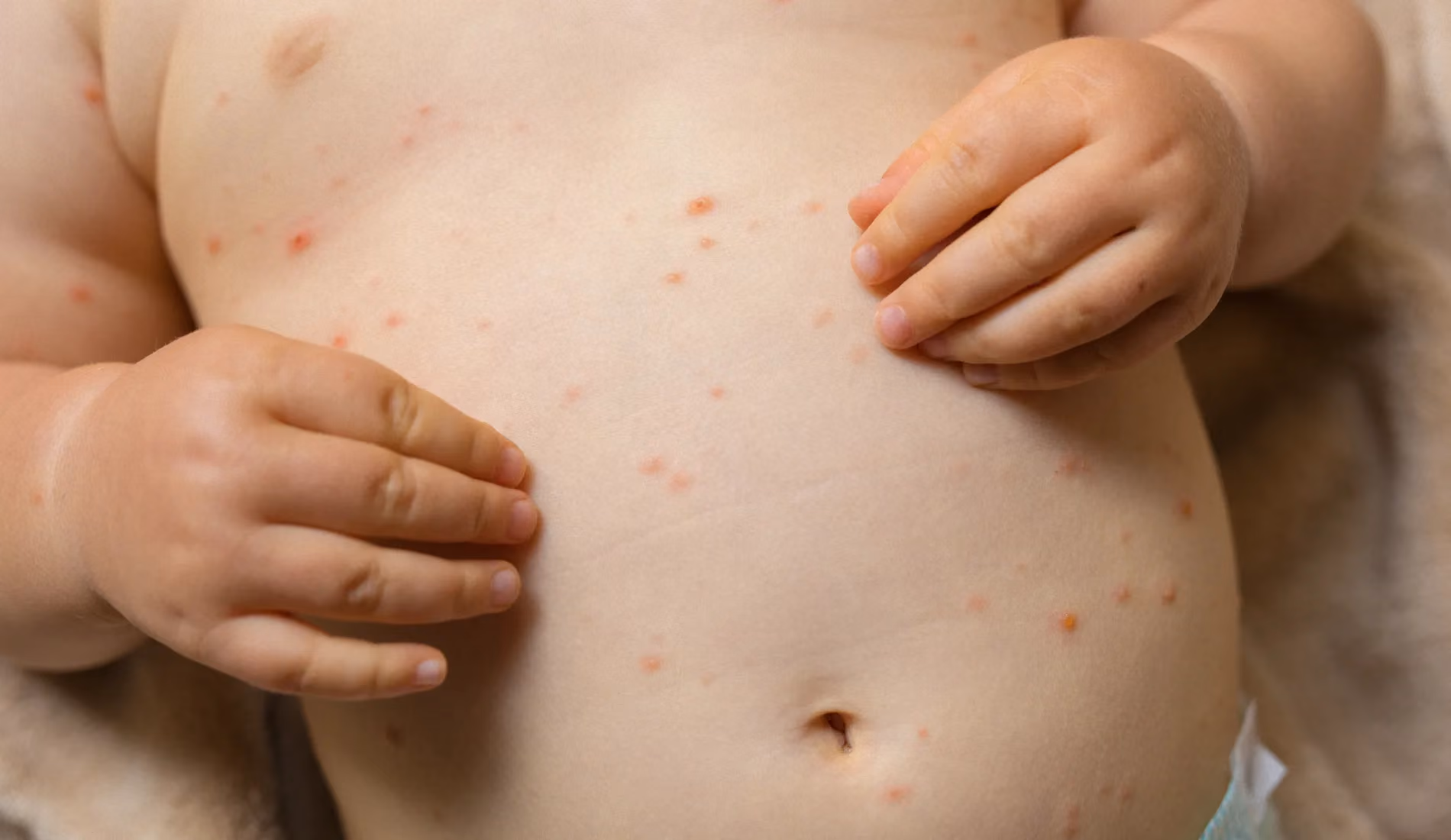La peau d'un bébé présentant des boutons de varicelle.