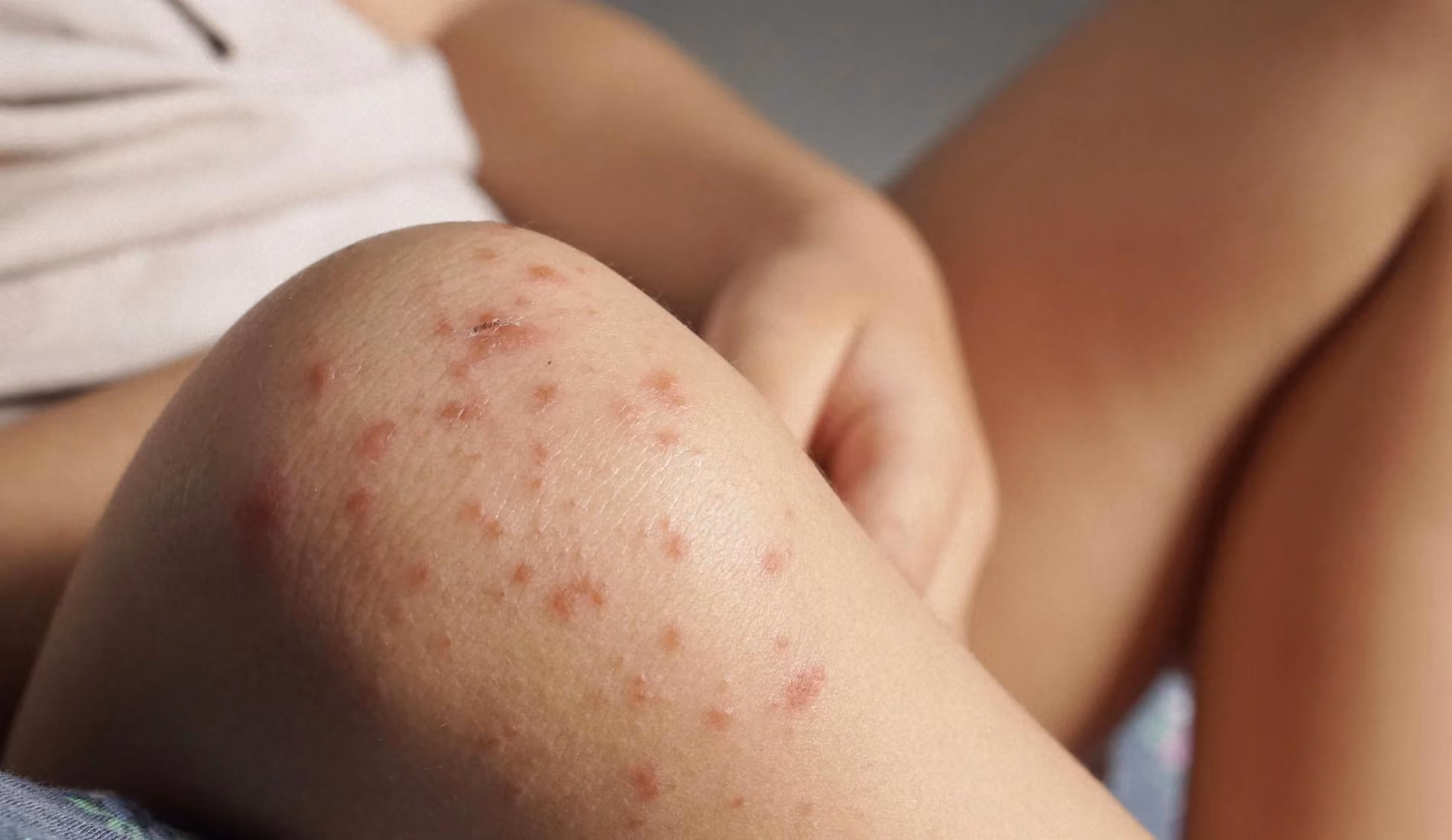 La peau d'un enfant recouverte de boutons de rougeole ou varicelle