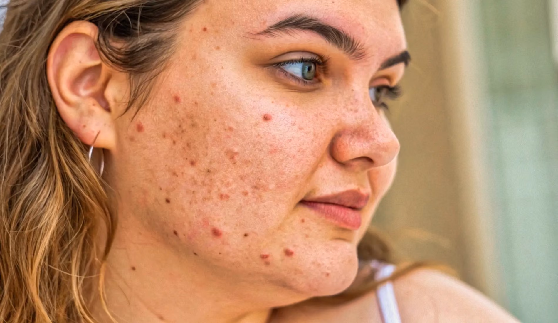 Le visage d'une femme plein de boutons et de poils, car elle souffre du syndrome des ovaires polykystiques (SOPK).
