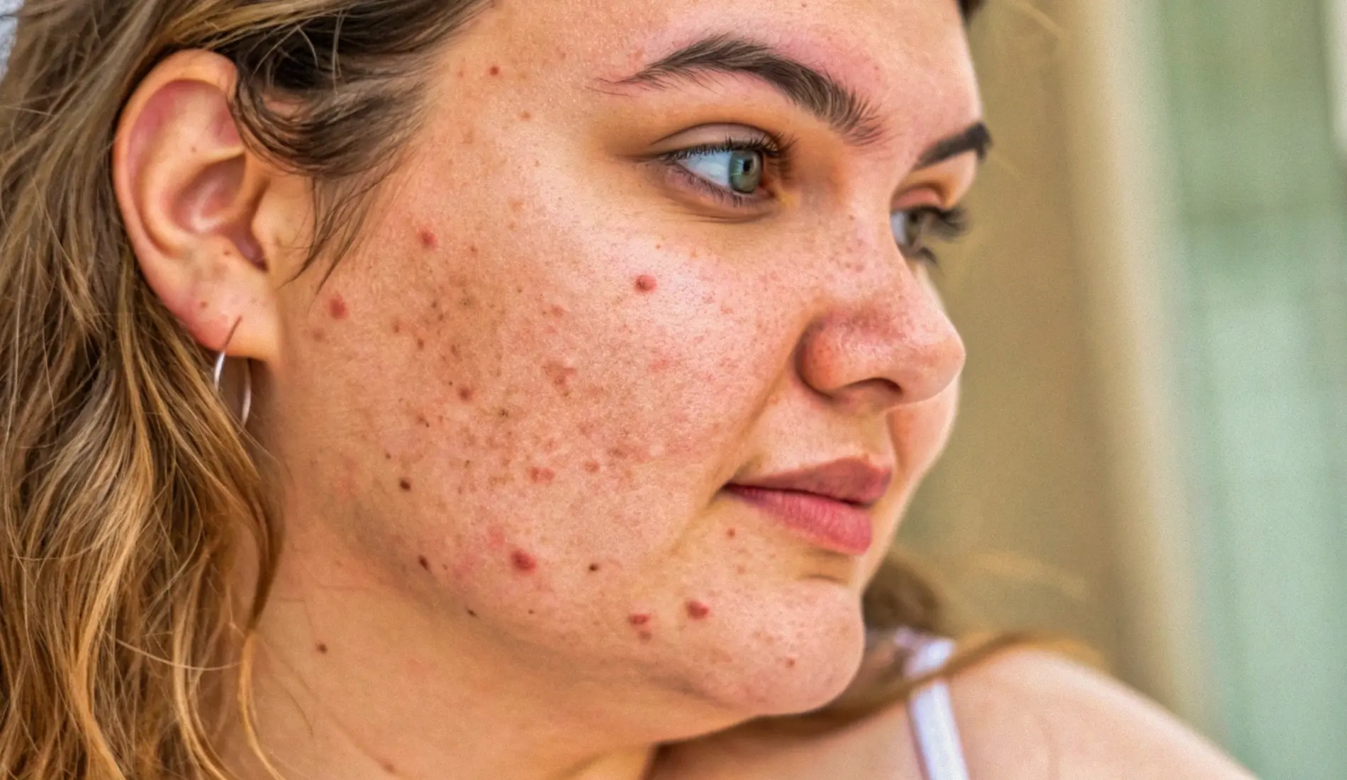 Le visage d'une femme plein de boutons et de poils, car elle souffre du syndrome des ovaires polykystiques (SOPK).