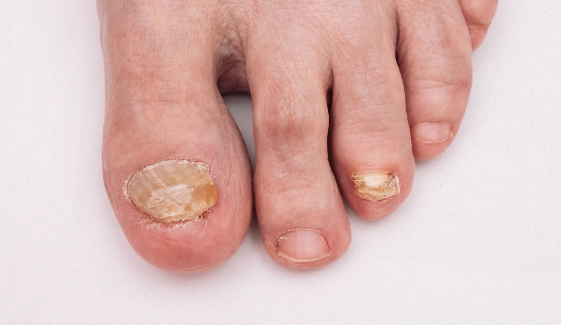 Des orteils atteints d'onychomycose.