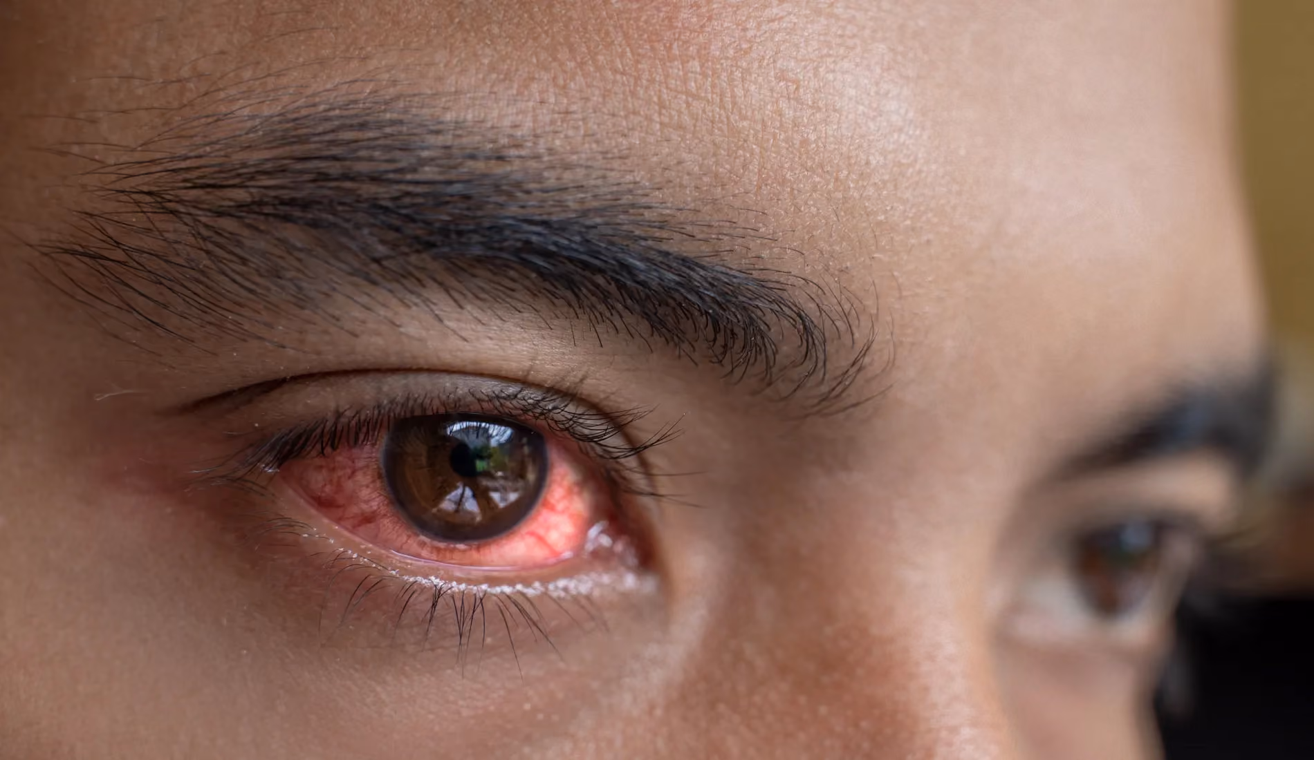 Une personne atteinte d'herpès oculaire. Son oeil est rouge.