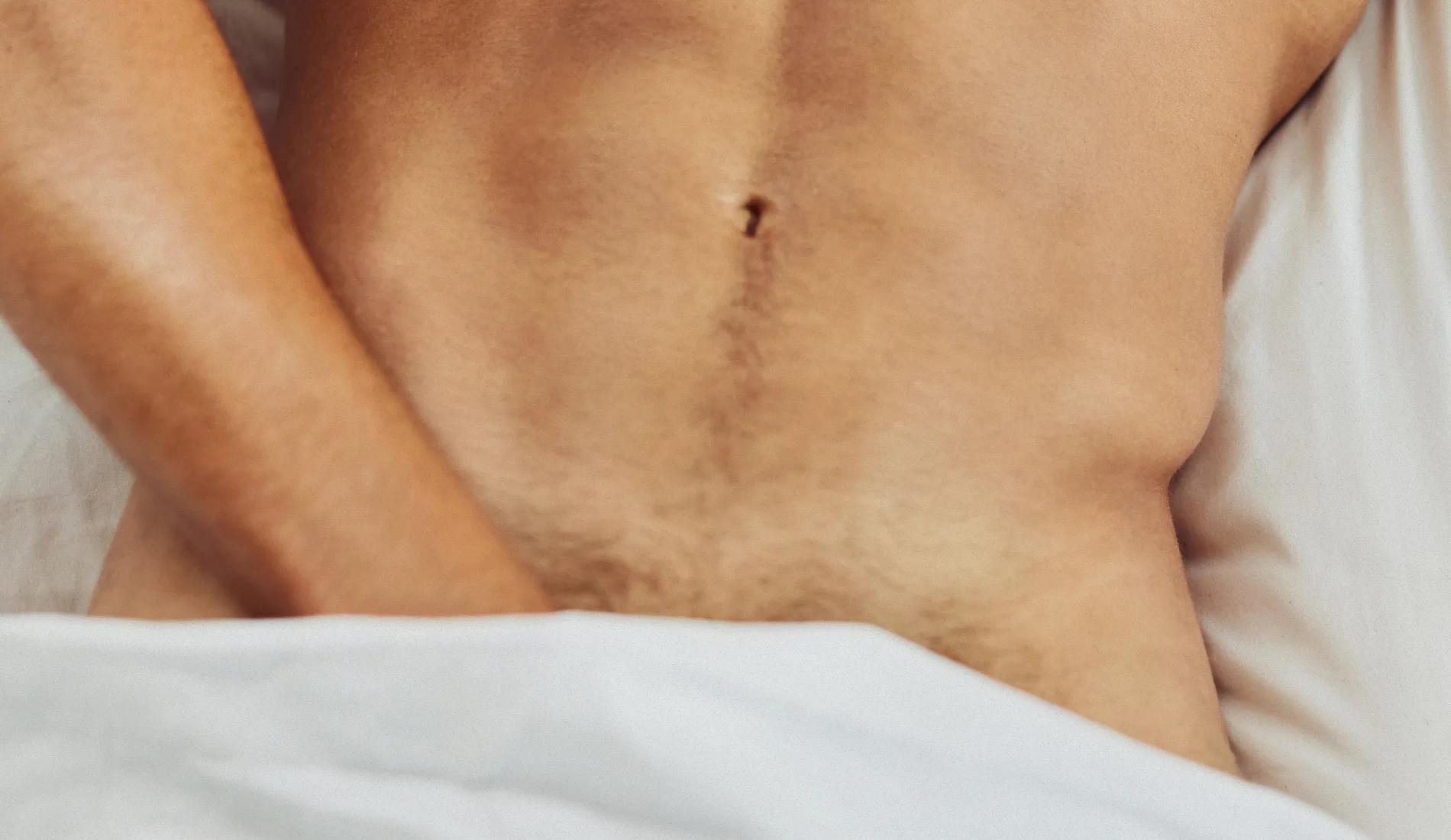 Le pubis d'un homme atteint d'herpès génital.