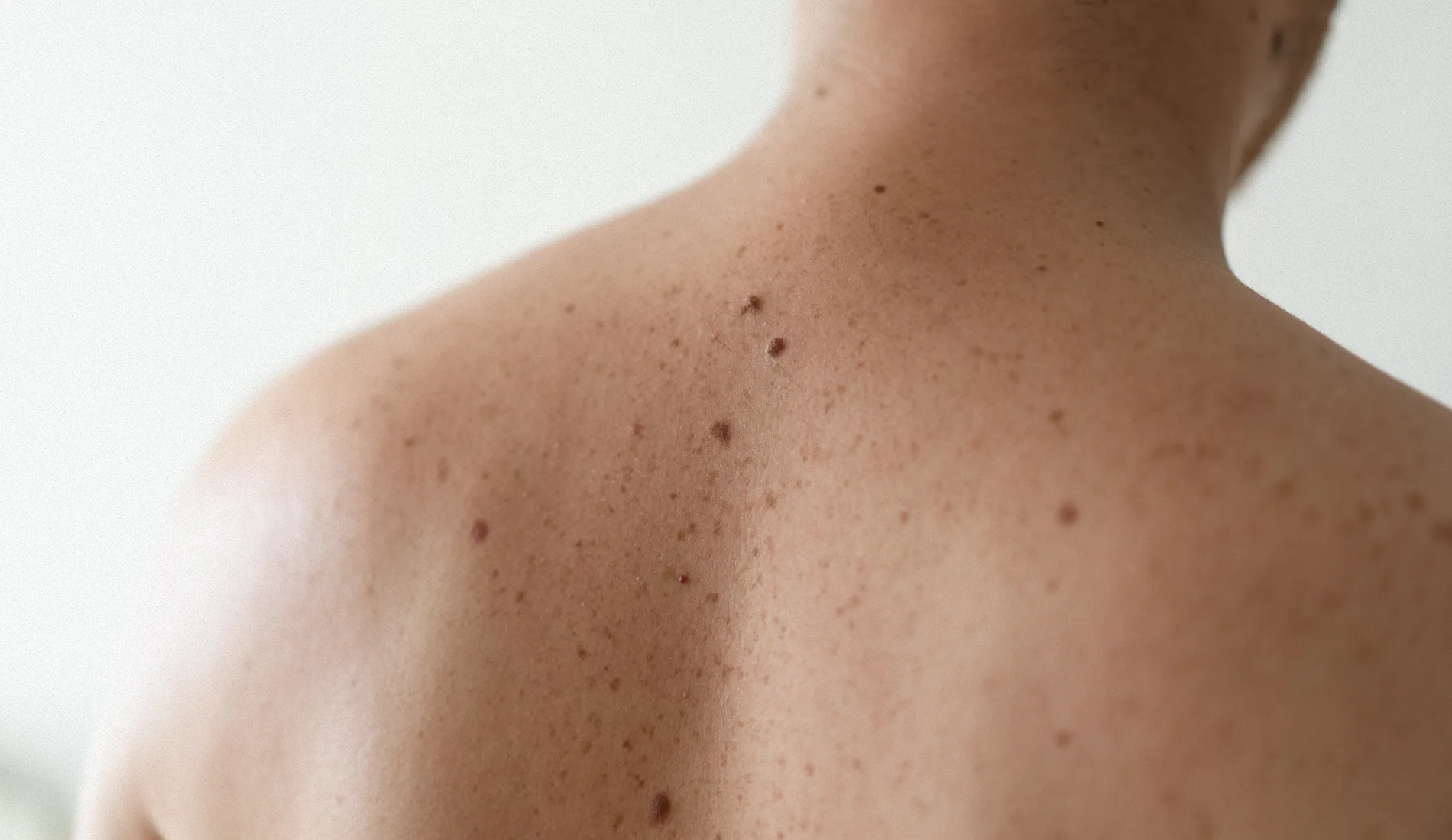 Gros plan sur la peau du dos présentant plusieurs grains de beauté, ce qui démontre l'importance de surveiller leur forme, couleur et évolution.