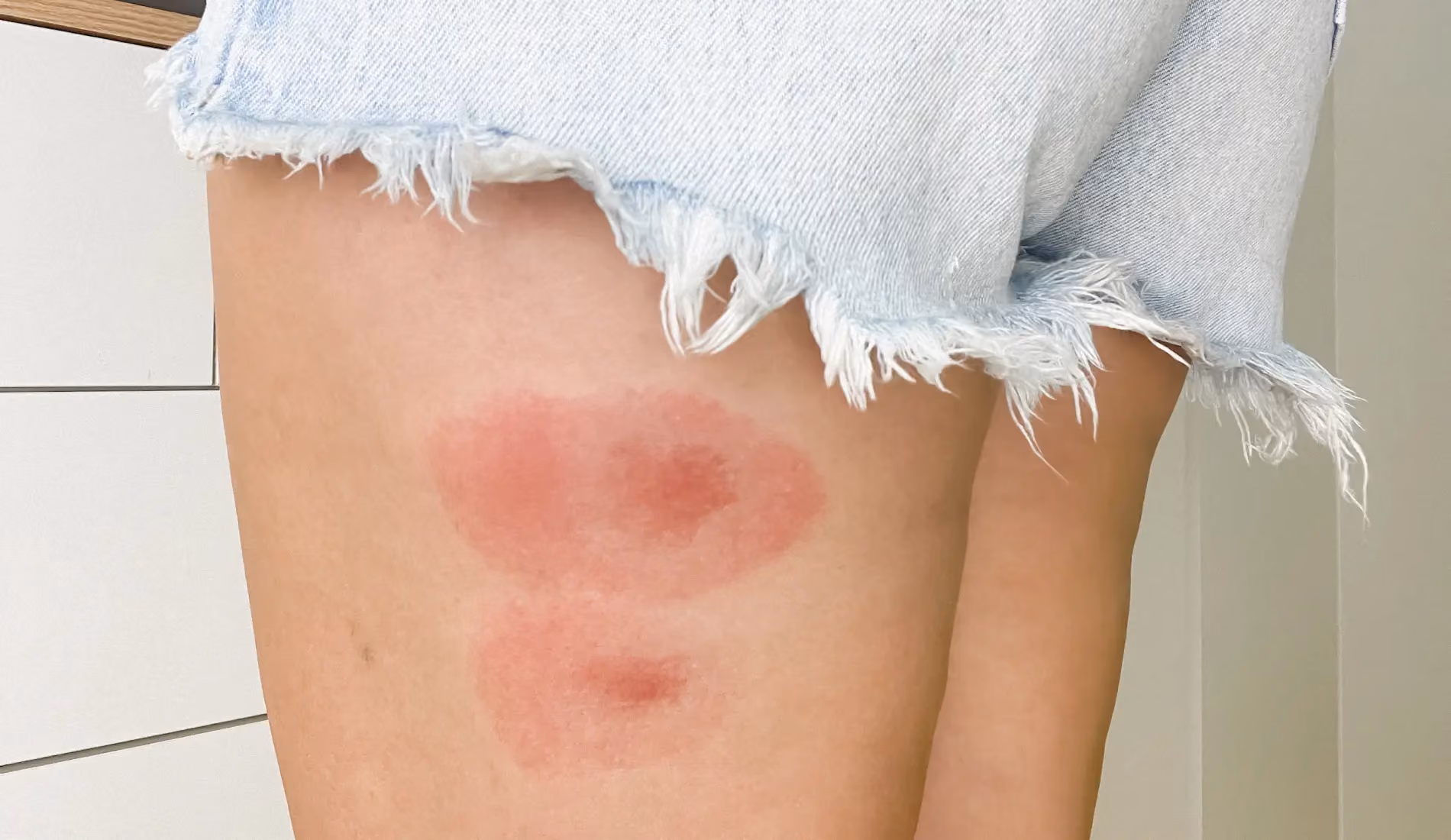 Gros plan sur une piqûre d'insecte sur la peau de la cuisse présentant une rougeur et un léger gonflement, réaction cutanée typique d'une piqûre de moustique ou de guêpe