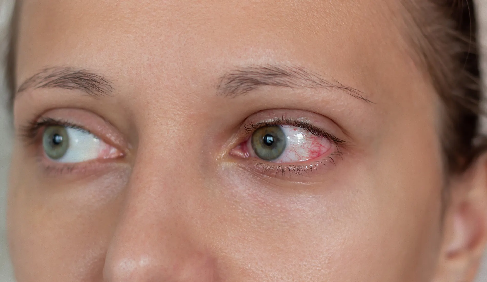 Une jeune femme avec un oeil rouge, signe d'une conjonctivite nécessitant un arrêt de travail.