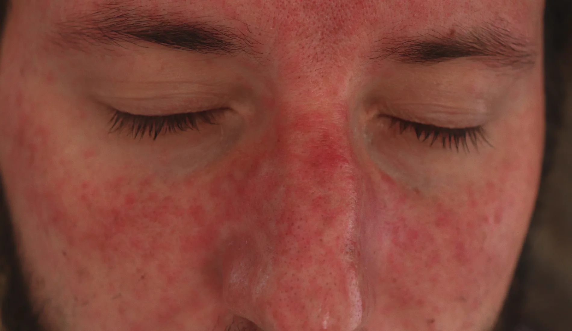 Une personne présentant un visage rouge dû à une maladie comme la rosacée.