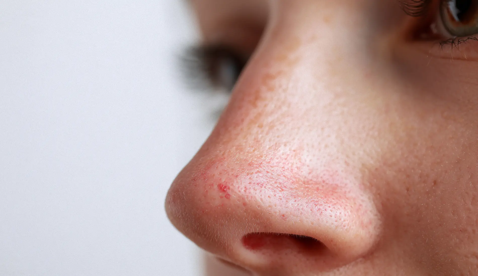 Une femme de profil, qui présente une rougeur de nez.