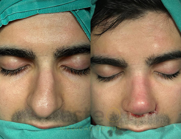 Nose job before-after results with Este Medical