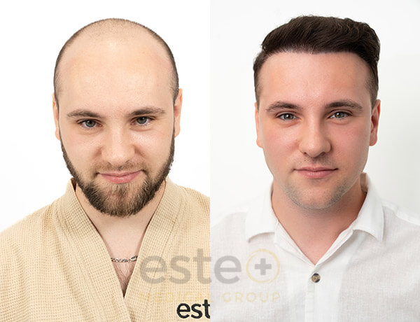 Hair transplant before and after Leeds