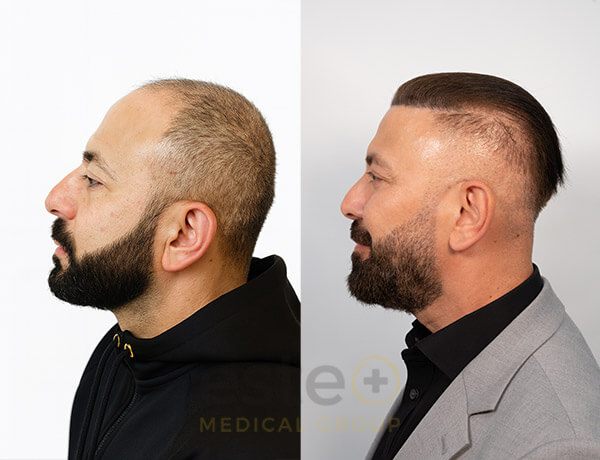 Hair transplant before and after Leeds