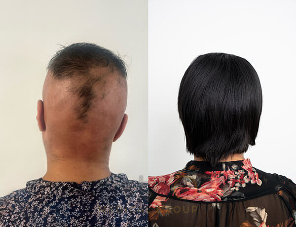 Magna's Alopecia Journey with Este Medical