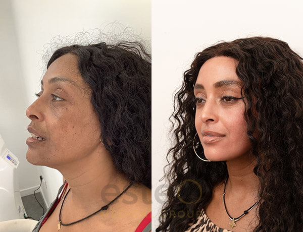 Helena's Pigmentation story with Este Medical
